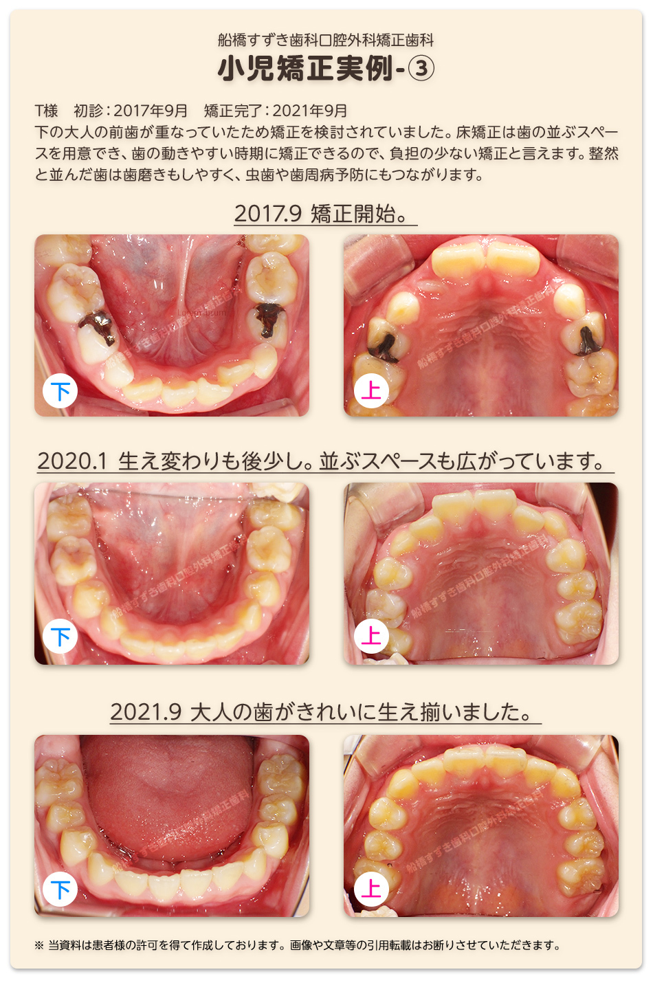 船橋すずき歯科口腔外科矯正歯科の小児矯正実例３