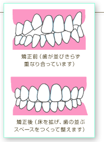 床矯正 小児矯正 船橋すずき歯科口腔外科矯正歯科 習志野台